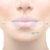 somnifix strips 1 dental hygienists abroad