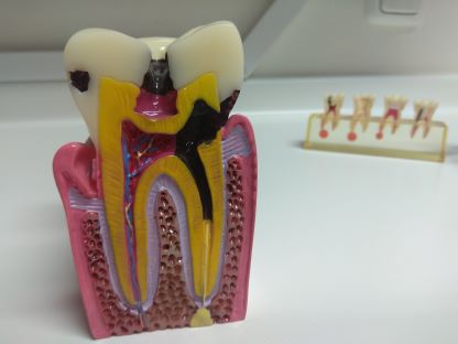 dental caries model